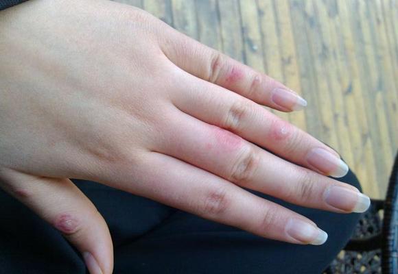 冻疮又痛又痒简单一头蒜就可解决