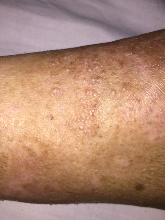 眼睛周围有白色的小点是不是疣,眼睛下边有白点不是脂肪粒是什么