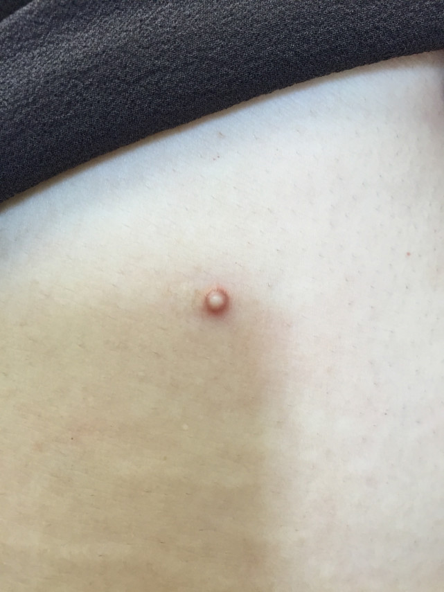 眼睛周围有白色的小点是不是疣,眼睛下边有白点不是脂肪粒是什么