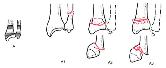 桡骨远端骨折传统石膏打法,成人桡骨远端骨折诊疗指南2023版