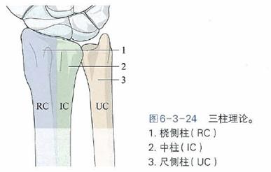 桡骨远端骨折传统石膏打法,成人桡骨远端骨折诊疗指南2023版
