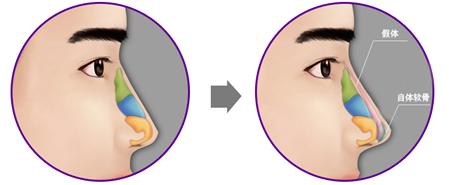 隆鼻太可怕怎么办,硅胶隆鼻正确方法图