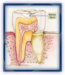 蛀牙怎样才能控制住不再有蛀牙,蛀牙怎么避免更严重
