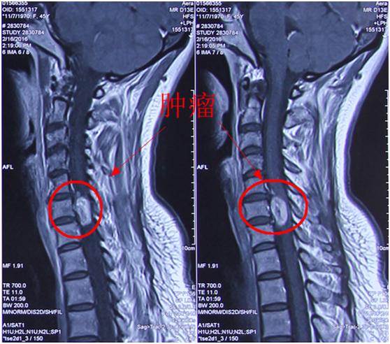 病例分享最后总结,颈静脉孔区神经鞘瘤全切复发概率