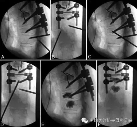 骨科经典案例分享,骨科微创实例