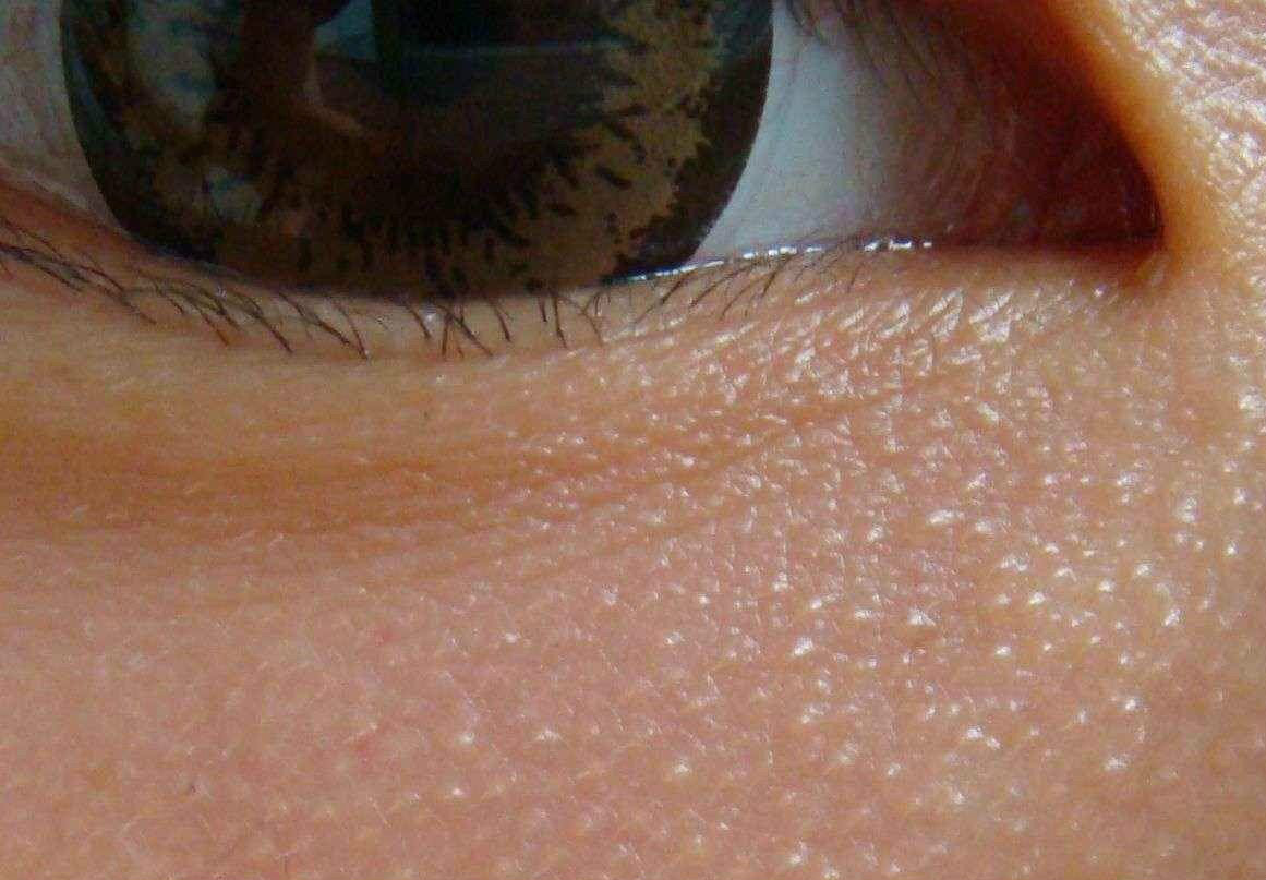 眼睛上有个小颗粒是什么,眼睛上的脂肪粒叫什么