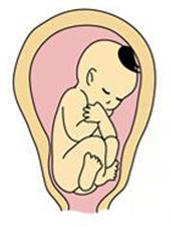 臀位宝宝成功顺产,固执的妈妈断送了孩子的生命