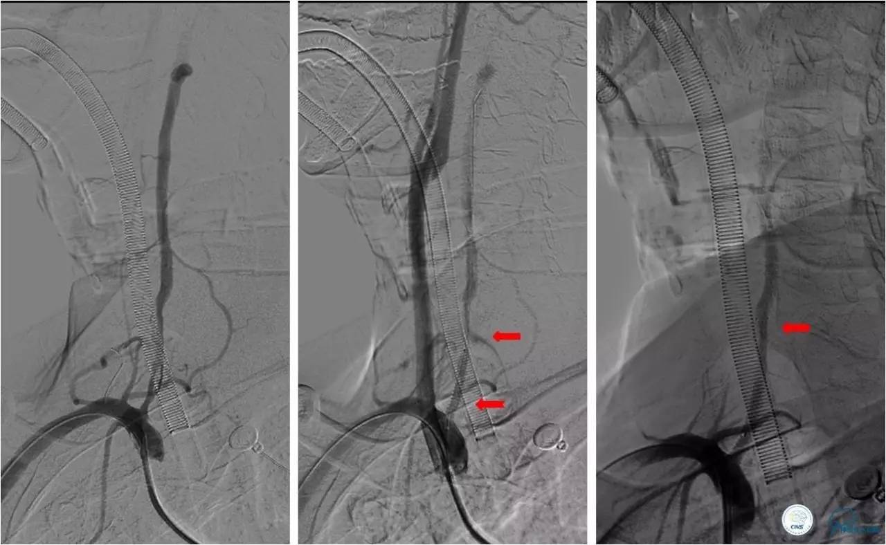 后循环系统梗死,后循环梗死