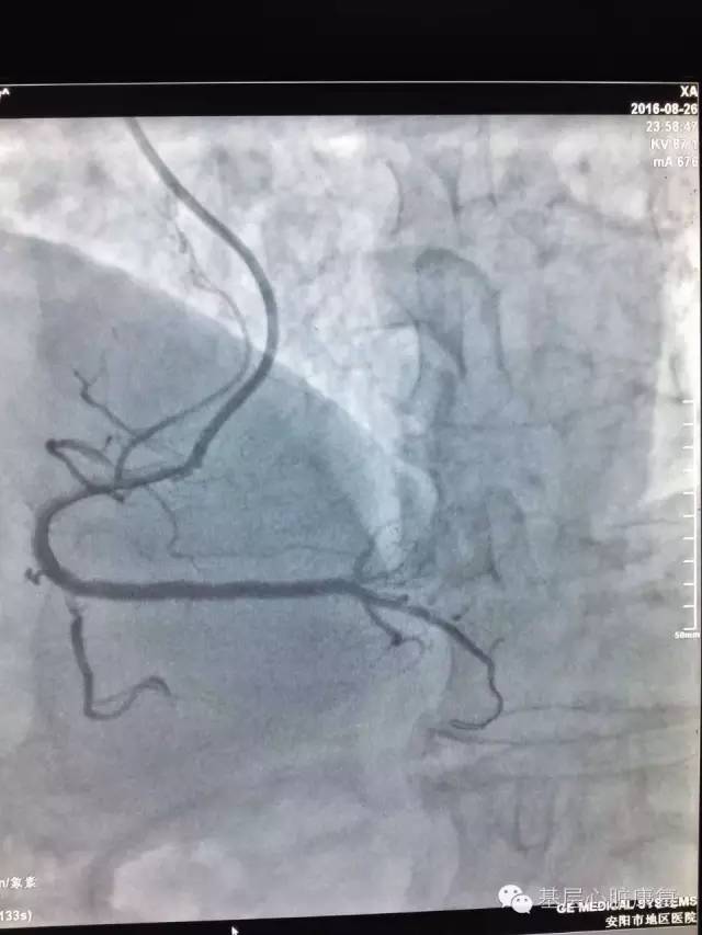 攻克冠心病,治疗冠心病的高科技