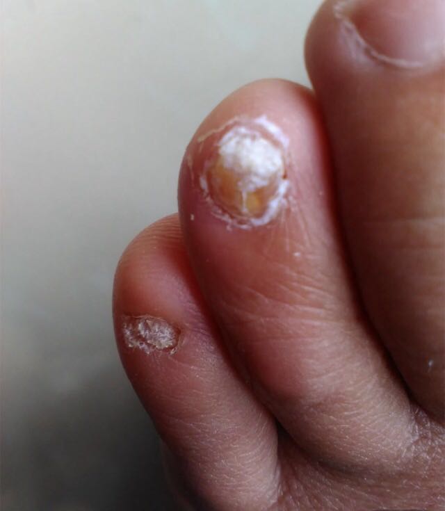 小孩手指甲分成两层是怎么回事,灰指甲指甲盖分离是好事还是坏事