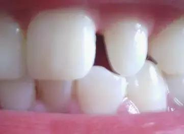 前牙有缝有什么说法吗,前牙有洞怎么补救