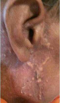 腮腺癌的治疗方案,腮腺癌用啥药治疗