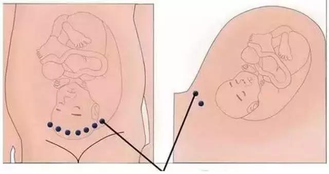 横切剖宫产后的疤痕,剖腹产横切和竖切二年愈合照片