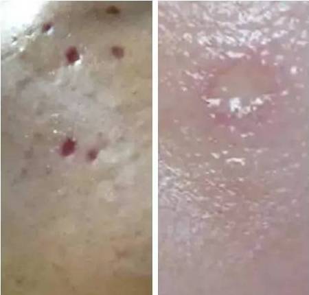 痣该不该祛,有痣需要去掉吗