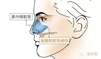 用自体肋软骨隆鼻效果,鼻中隔隆鼻和耳软骨隆鼻哪个好些