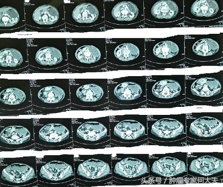 农村老人吃了吐，吐了再吃，坚持不了才就医，一查竟是胃癌晚期