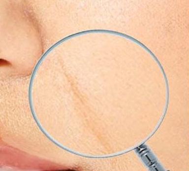 痘痘肌肤毛孔粗大做什么医美,痘痘毛孔粗大怎么修复平价