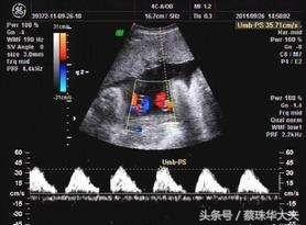 怀孕22周，脐血流检测SD4.3是否偏高？怎么降低？