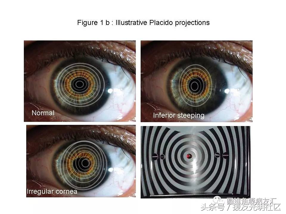 角膜地形图诊断标准,角膜地形图能确诊圆锥角膜