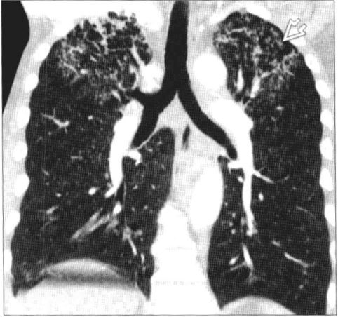 世界防治结核病日历史,世界结核病日来历