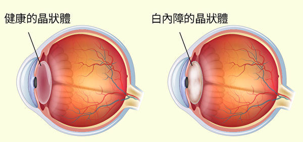 白内障怎么预防和保养,失明怎么可以预防