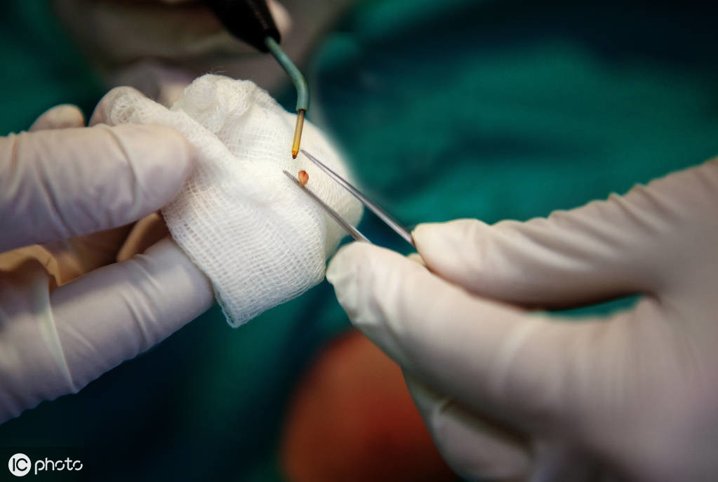 治尖锐性湿疣哪种方法有效果,长沙中医治疗尖锐性湿疣