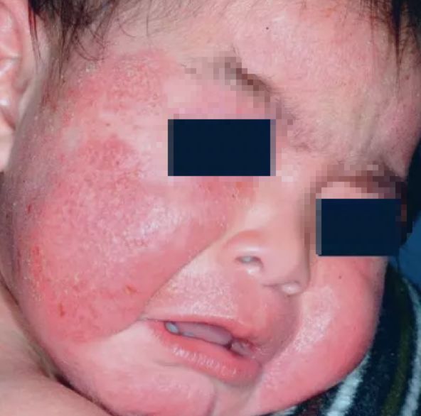 8款湿疹膏，2款含有激素，有效还是有害？