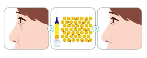 自体脂肪填充全脸逆袭,自体脂肪填充的真相来了