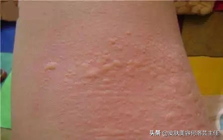 慢性荨麻疹治好了还需要忌口吗,麻疹怎么解释