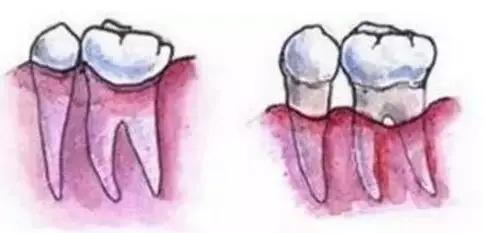 雅悦齿科烤瓷牙视频,雅悦齿科治疗费用