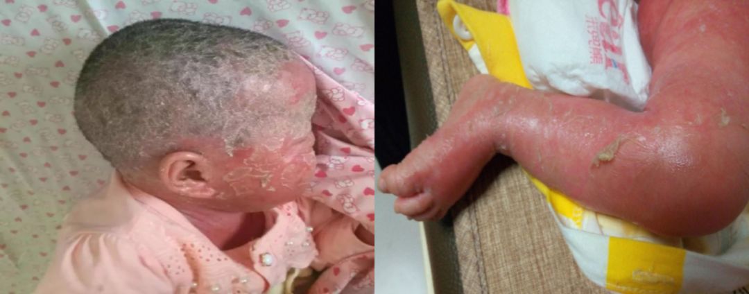 宝宝出生全身脱皮皮肤很红,出生半月的婴幼儿皮肤脱皮