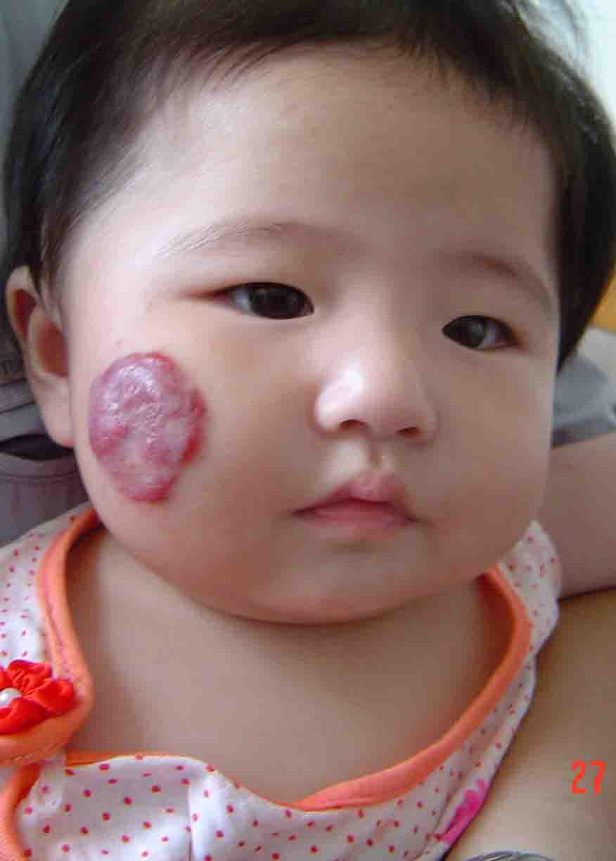 大面积婴儿血管瘤,婴幼儿血管瘤的危险因素