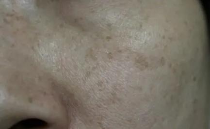 褐斑吃什么食物可以改善,褐斑处理比较快