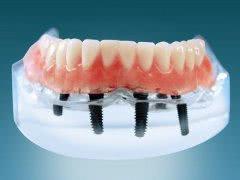 牙可以种植吗种植牙是什么,种植牙和自己的牙齿有什么区别