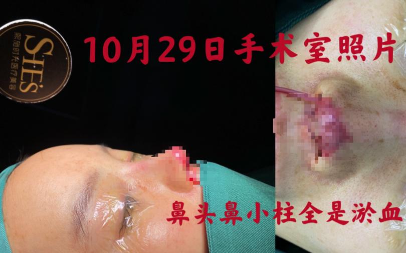 24岁女星整形遇毁容，前途尽毁面临200万赔偿，抑郁险自杀