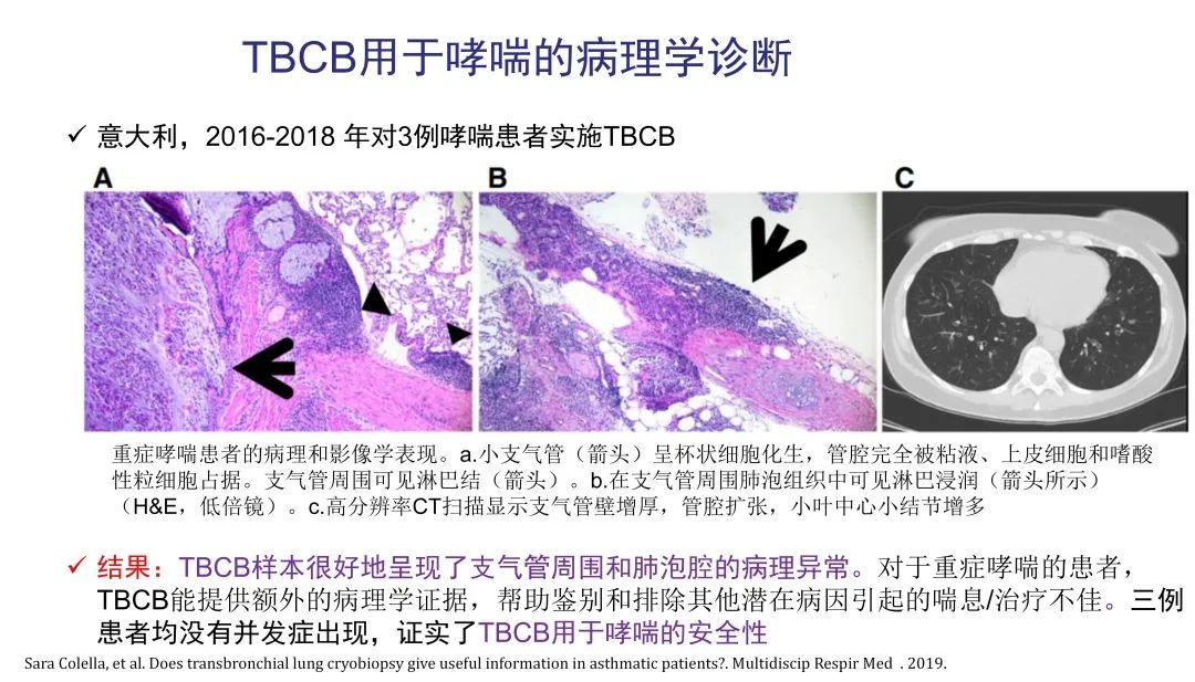 经皮肺穿刺活检术过程,经支气管冷冻肺活检
