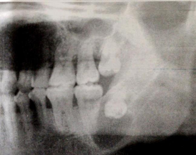 口腔龋齿发病原因讲座,口腔医生科普龋齿处理