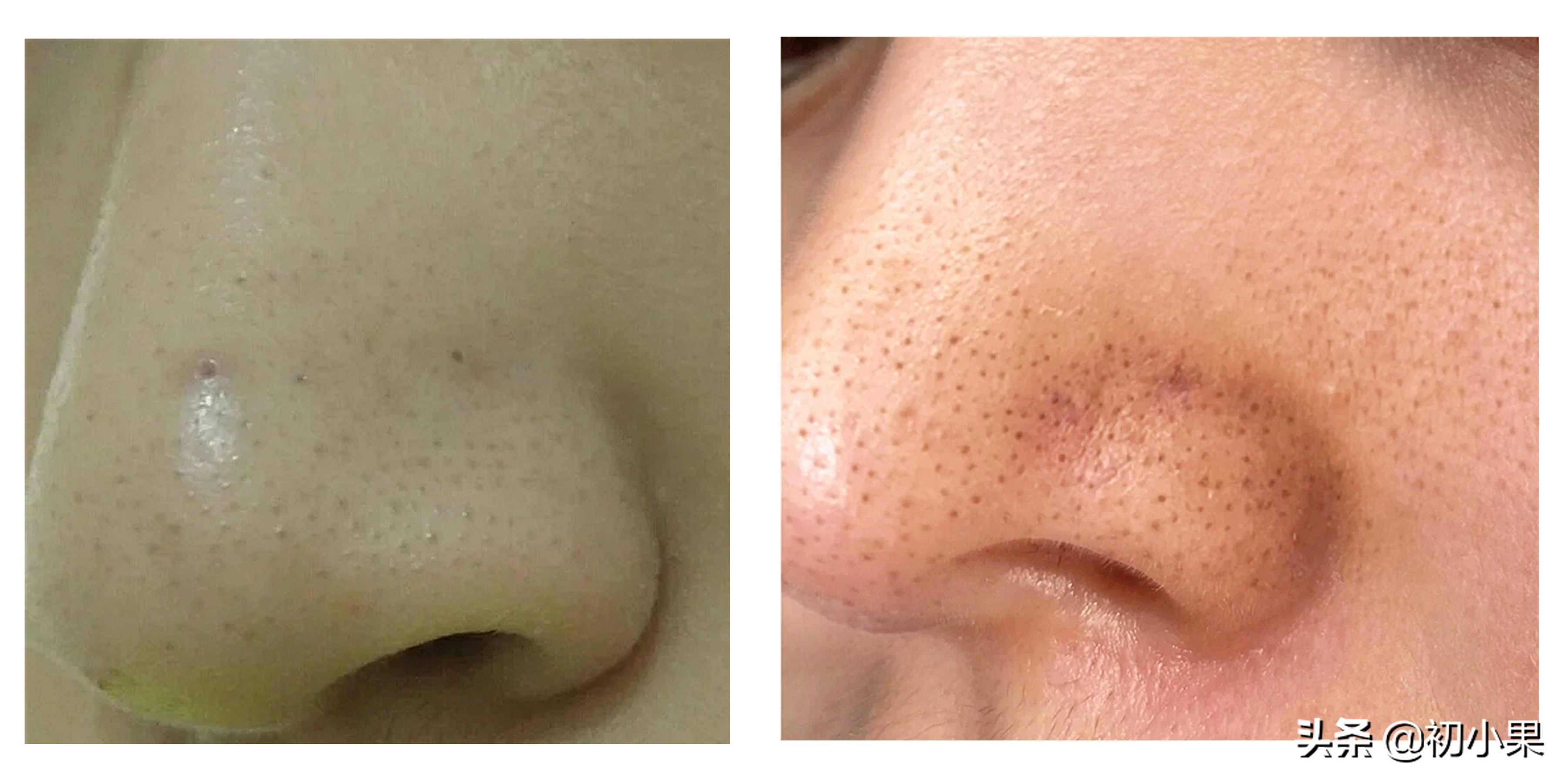 鼻子上的黑头怎么去除,鼻子上的黑头怎么去除儿童