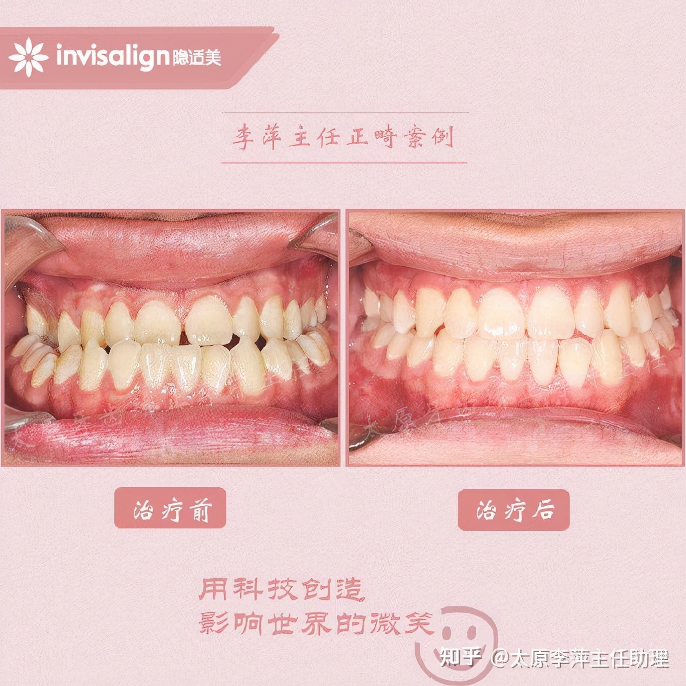 重度拥挤矫正牙齿适合隐形牙套吗,广州成人牙齿矫正推荐隐形牙套