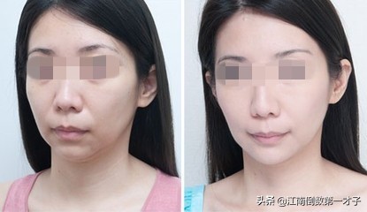 为什么射频消融术后容易复发,为什么射频消融术不除根