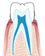 种不了种植牙还有其它办法吗,一直犹豫种牙还是镶牙
