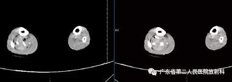 这个病例让我大涨知识：14岁男性右小腿痛性包块