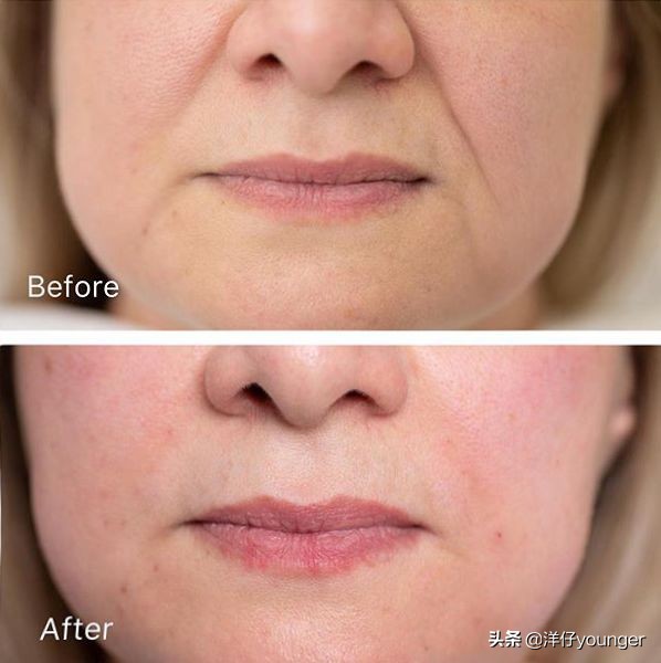 如何解决嘴角的法令纹,怎么去除嘴角纹最快最有效