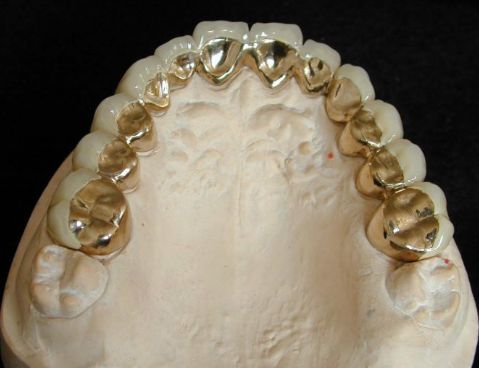 假牙价格一览表图片,假牙种类及价格表图片