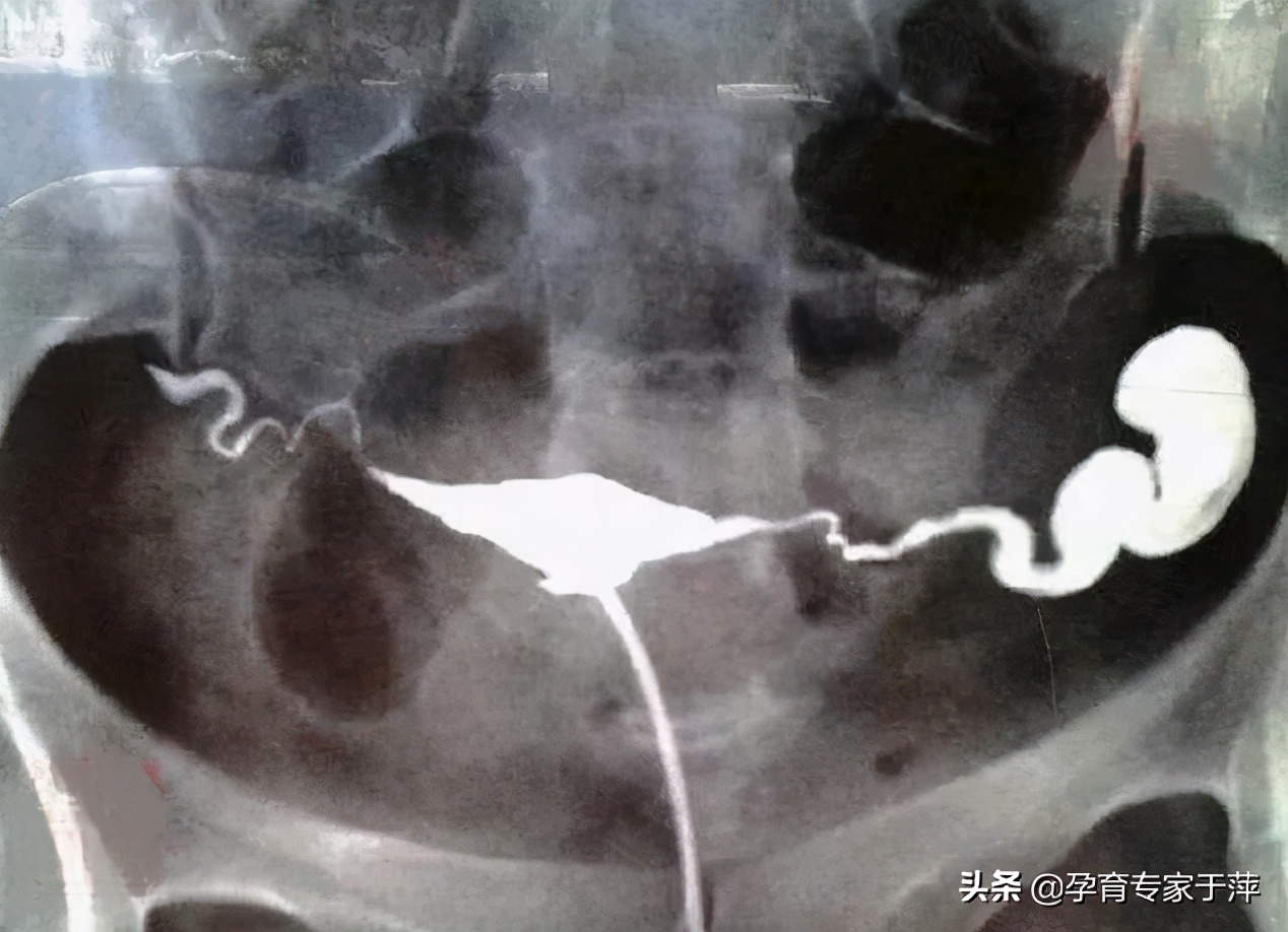 不孕不育专家于萍,输卵管不孕症的治疗