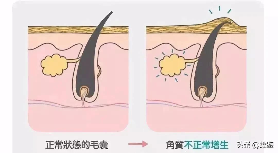 鸡皮肤怎么改造好看,鸡皮肤真难看到底应该怎么办