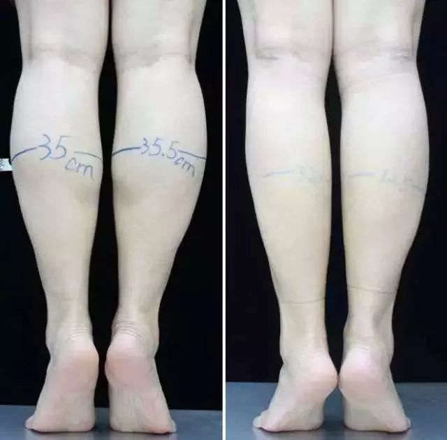 萝卜腿如何瘦下来矫正,萝卜腿怎么减掉