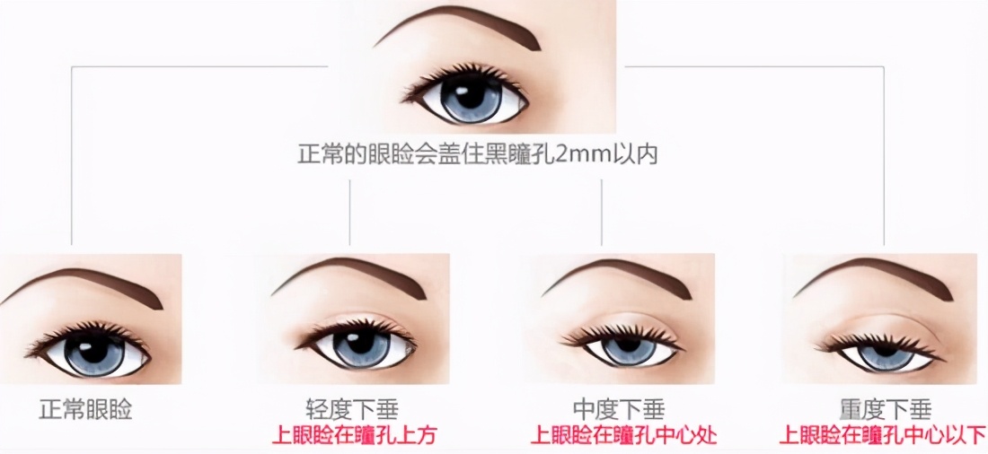 做双眼皮时判断出肌无力但未提肌,做双眼皮说是眼睛肌力不够