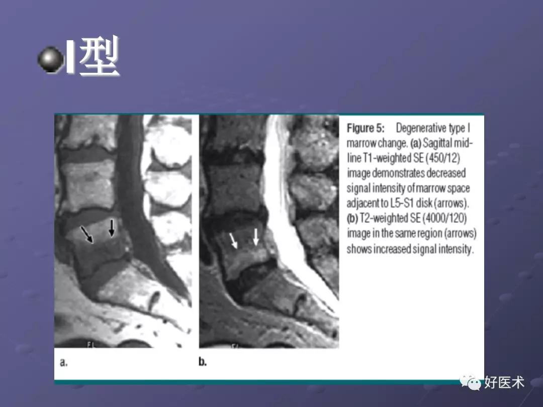 脊柱mri有哪些特点,乳腺疾病的mri诊断及鉴别