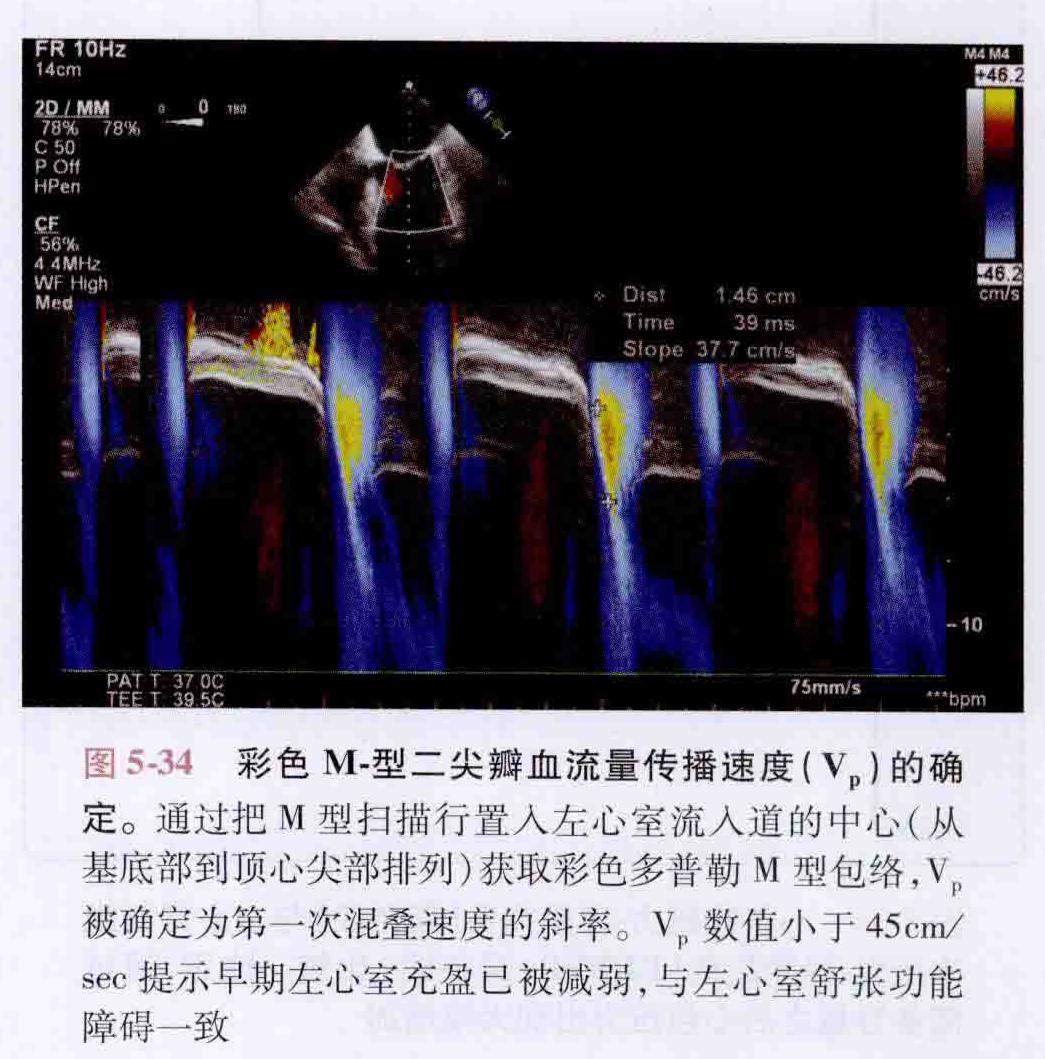 卡普兰心脏麻醉学（超声时代）学习笔记24